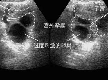 详细解读宿迁市做长方案试管婴儿费用，长方案和短方案成功率有差别吗？